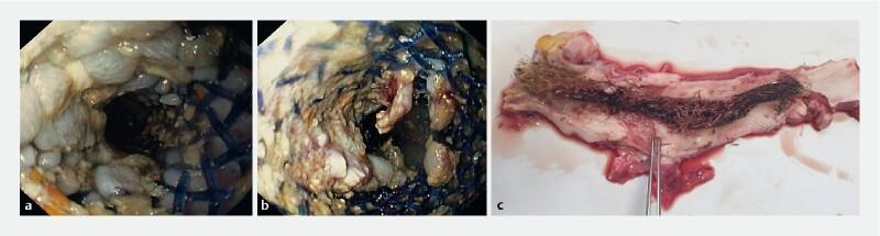 https://cdn.ncbi.nlm.nih.gov/pmc/blobs/309f/7581471/24cfc5baee71/10-1055-a-1261-3103-i1790ei6.jpg