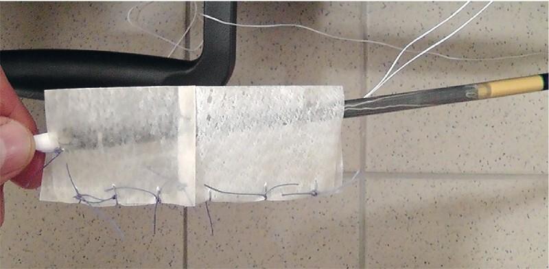 https://cdn.ncbi.nlm.nih.gov/pmc/blobs/309f/7581471/6580450ea102/10-1055-a-1261-3103-i1790ei2.jpg