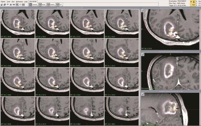 https://cdn.ncbi.nlm.nih.gov/pmc/blobs/30ab/6129753/4f395d3466dc/jkns-2017-0303-005f2.jpg