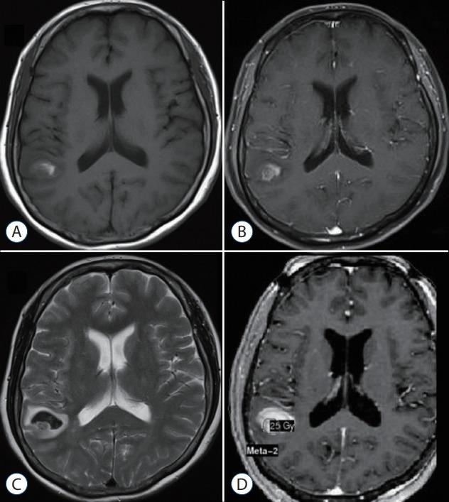 https://cdn.ncbi.nlm.nih.gov/pmc/blobs/30ab/6129753/82e2dbb80211/jkns-2017-0303-005f1.jpg