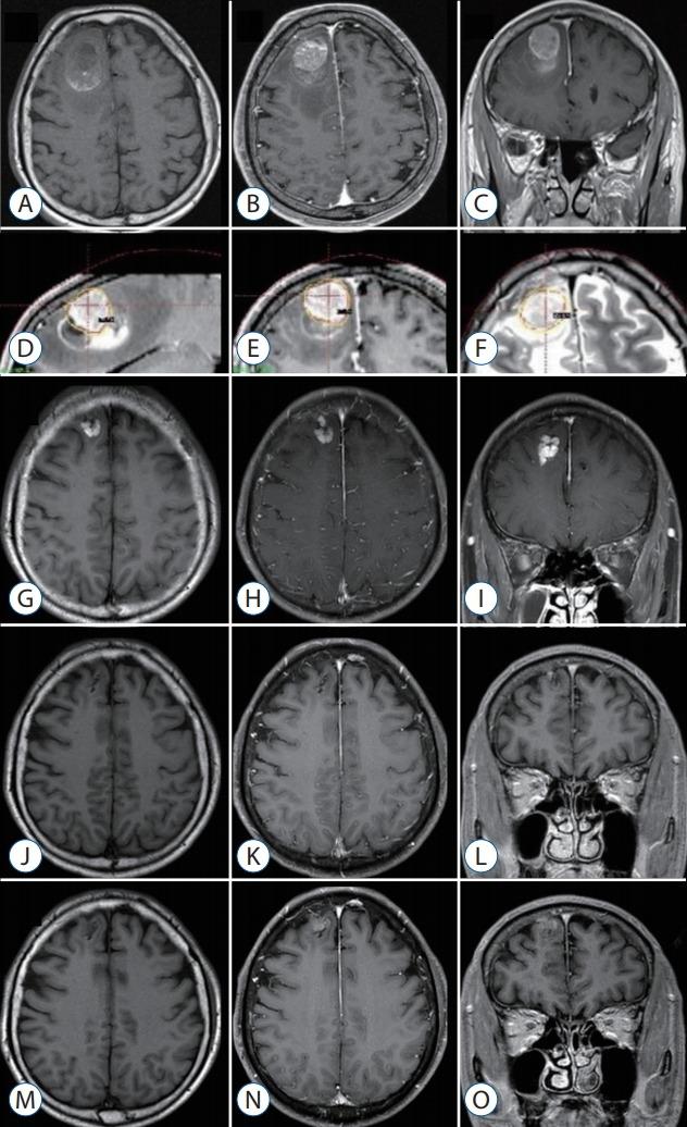 https://cdn.ncbi.nlm.nih.gov/pmc/blobs/30ab/6129753/840f93ecdb7a/jkns-2017-0303-005f5.jpg