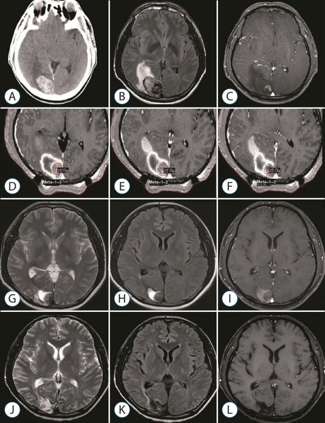 https://cdn.ncbi.nlm.nih.gov/pmc/blobs/30ab/6129753/98694c68b49f/jkns-2017-0303-005f4.jpg