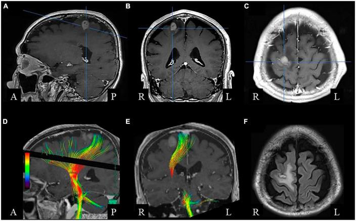 https://cdn.ncbi.nlm.nih.gov/pmc/blobs/30d4/10568456/5f62551fdaab/fnins-17-1217430-g001.jpg