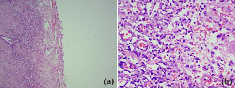 https://cdn.ncbi.nlm.nih.gov/pmc/blobs/30f6/11218490/8ef1e01f0cf7/cureus-0016-00000063579-i08.jpg