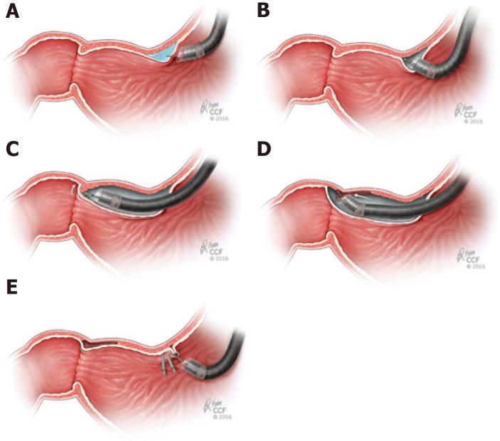 https://cdn.ncbi.nlm.nih.gov/pmc/blobs/30fa/7739143/da127a88aba2/WJGE-12-521-g002.jpg