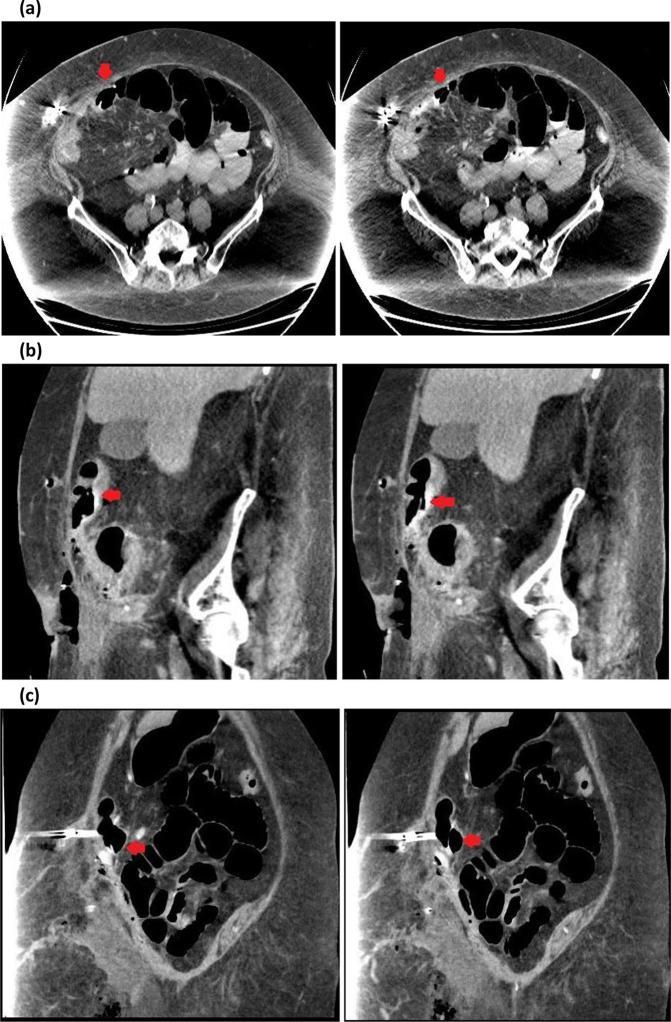 https://cdn.ncbi.nlm.nih.gov/pmc/blobs/310e/6438395/aeea8c15ba0c/bjrcr.20170097.g002.jpg