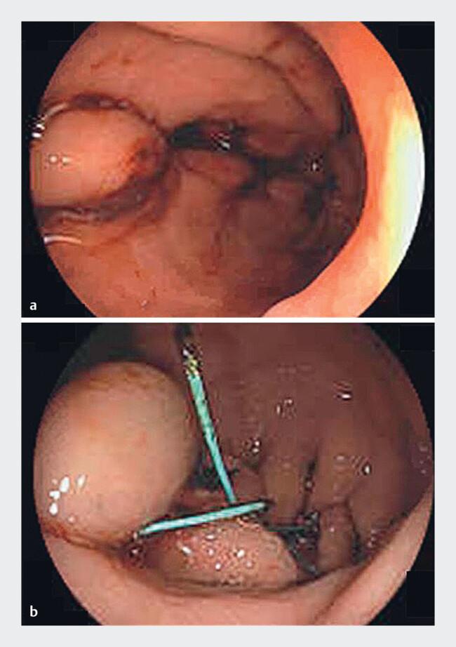 https://cdn.ncbi.nlm.nih.gov/pmc/blobs/313d/11651918/0addf7a76ea7/10-1055-a-2463-9784_24683789.jpg