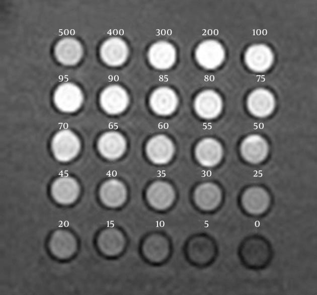 https://cdn.ncbi.nlm.nih.gov/pmc/blobs/3173/4389174/ebc1f52d9b62/Iranjradiol-12-02-22887-g001.jpg