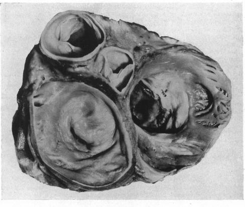 https://cdn.ncbi.nlm.nih.gov/pmc/blobs/31aa/503827/1a22fb2fce81/brheartj00402-0079-a.jpg