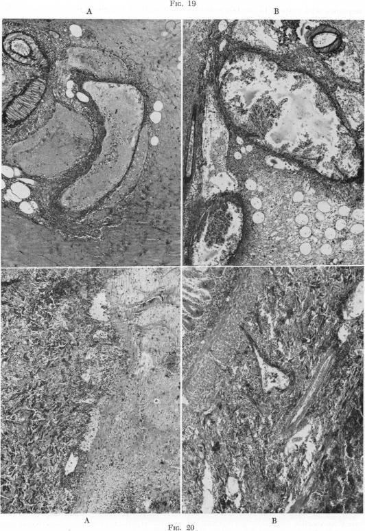https://cdn.ncbi.nlm.nih.gov/pmc/blobs/31bd/1802341/a92352ab012e/annsurg01426-0074-a.jpg