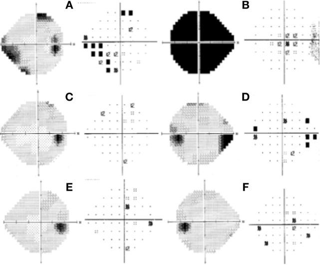 https://cdn.ncbi.nlm.nih.gov/pmc/blobs/31f5/5611380/168e790d9e70/fneur-08-00490-g002.jpg