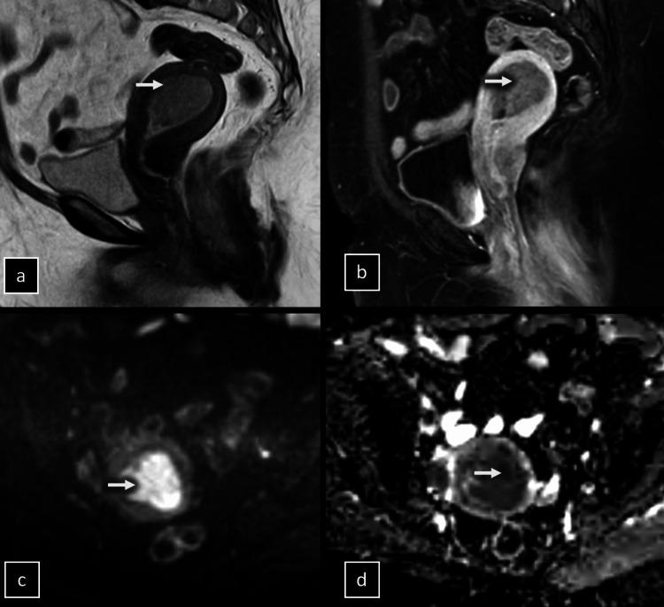 https://cdn.ncbi.nlm.nih.gov/pmc/blobs/3299/11238663/3a4274861976/cureus-0016-00000062111-i01.jpg
