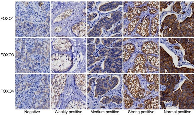 https://cdn.ncbi.nlm.nih.gov/pmc/blobs/330d/5707102/d83397d508fb/oncotarget-08-96313-g001.jpg