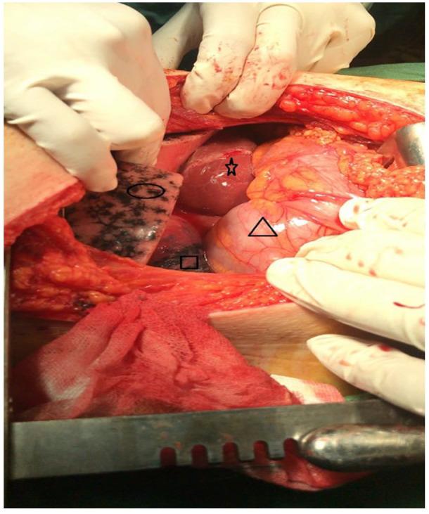 https://cdn.ncbi.nlm.nih.gov/pmc/blobs/3322/9926363/0c6f1ad95c32/10.1177_11795476231153283-fig3.jpg