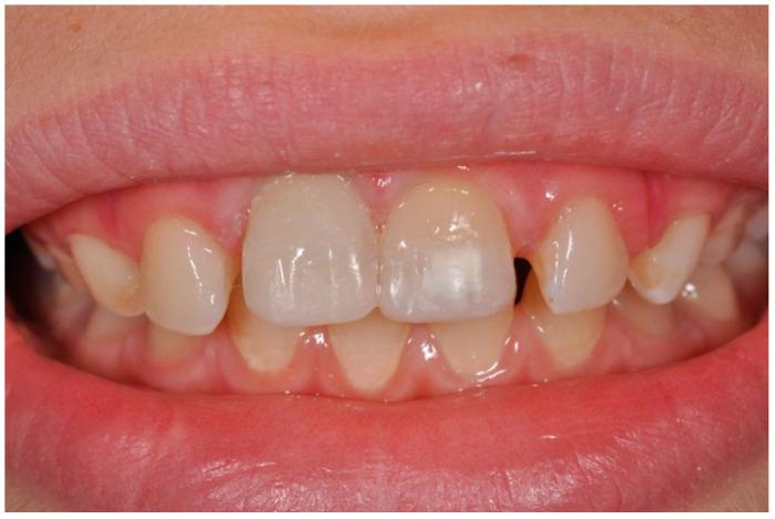 https://cdn.ncbi.nlm.nih.gov/pmc/blobs/332f/8233981/7ba8c4278b2e/dentistry-09-00072-g006.jpg