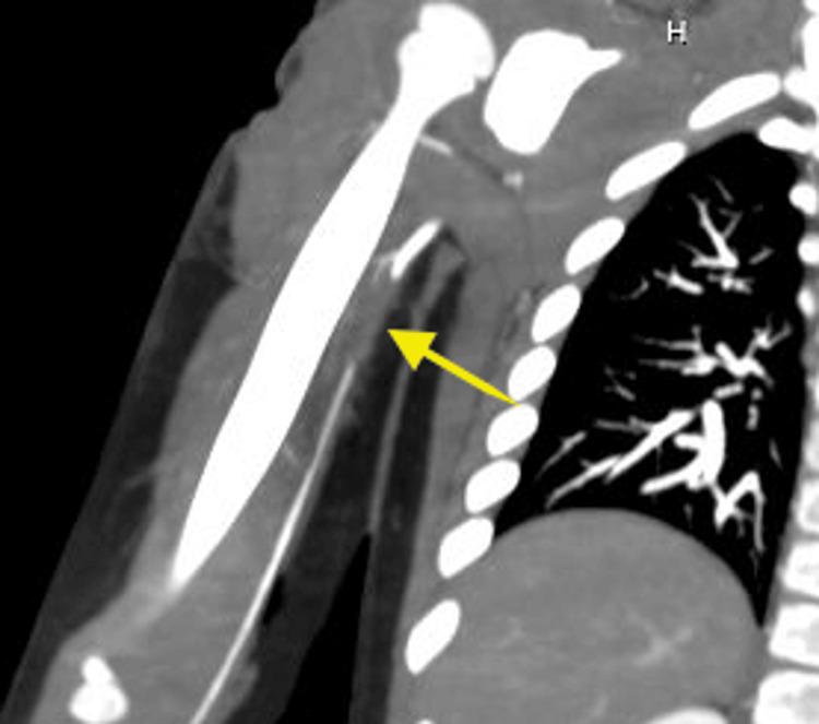 https://cdn.ncbi.nlm.nih.gov/pmc/blobs/3355/10599209/6916e1405a2d/cureus-0015-00000045889-i01.jpg