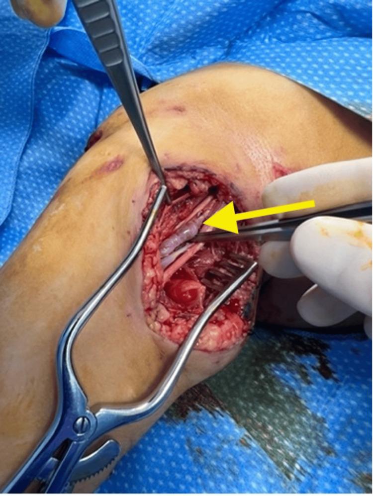 https://cdn.ncbi.nlm.nih.gov/pmc/blobs/3355/10599209/cde89b1887f5/cureus-0015-00000045889-i05.jpg