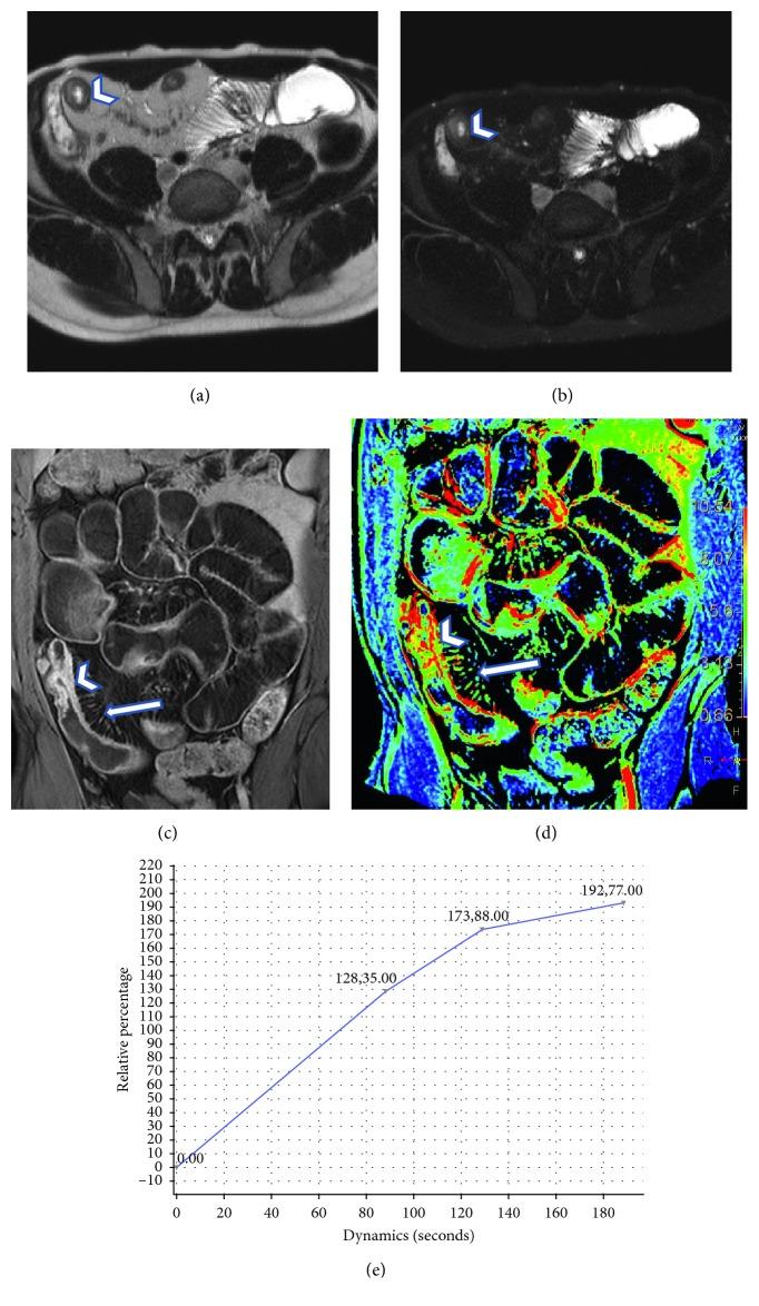 https://cdn.ncbi.nlm.nih.gov/pmc/blobs/3398/6378774/93f87eb91a67/CMMI2019-1767620.004.jpg