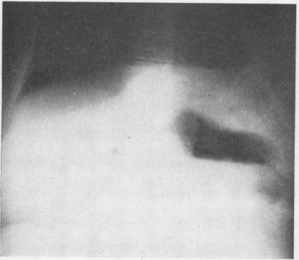 https://cdn.ncbi.nlm.nih.gov/pmc/blobs/33c7/471845/072c8ec5b5fd/thorax00101-0097-a.jpg