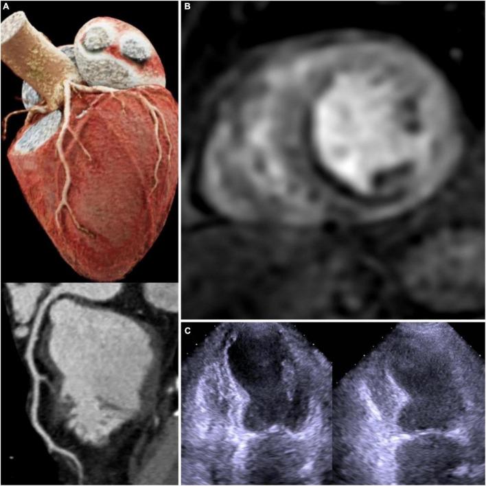 https://cdn.ncbi.nlm.nih.gov/pmc/blobs/3430/9722769/6419a966fa03/fcvm-09-1019529-g001.jpg