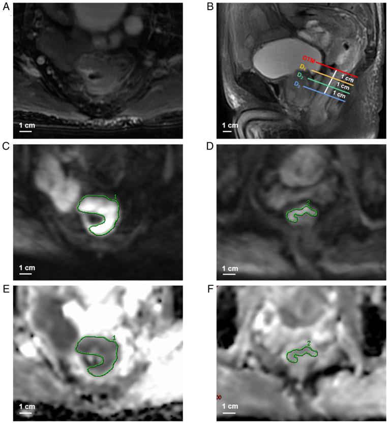 https://cdn.ncbi.nlm.nih.gov/pmc/blobs/343f/11653244/f7151024be5c/ol-29-02-14843-g00.jpg