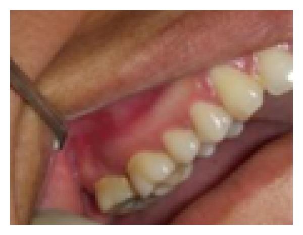 https://cdn.ncbi.nlm.nih.gov/pmc/blobs/347b/3399371/7ad9152c927c/CRIM.DENTISTRY2012-767582.006.jpg