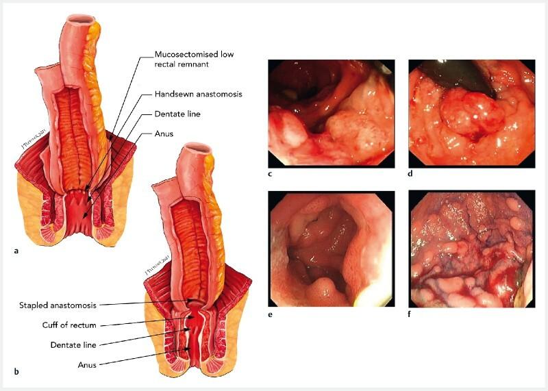 https://cdn.ncbi.nlm.nih.gov/pmc/blobs/3488/10465241/00c1386b0f3a/10-1055-a-2038-0541-i21802en1.jpg