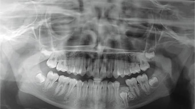 https://cdn.ncbi.nlm.nih.gov/pmc/blobs/34d7/8060928/c9d1fde87aca/ijcpd-13-729-g005.jpg