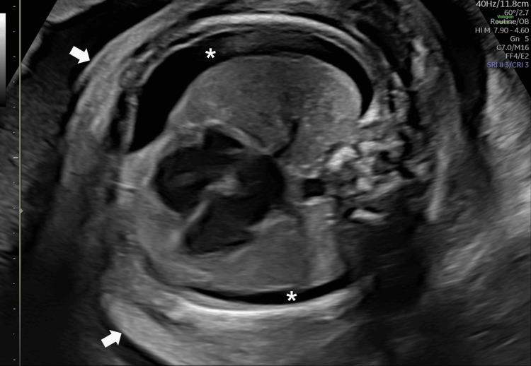 https://cdn.ncbi.nlm.nih.gov/pmc/blobs/3562/11254385/26caa9bb0d90/cureus-0016-00000062552-i01.jpg