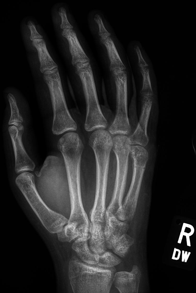 https://cdn.ncbi.nlm.nih.gov/pmc/blobs/3578/10255934/1c98b47533ce/cureus-0015-00000038845-i06.jpg