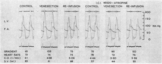https://cdn.ncbi.nlm.nih.gov/pmc/blobs/3585/490137/a69a12b34889/brheartj00336-0092-c.jpg