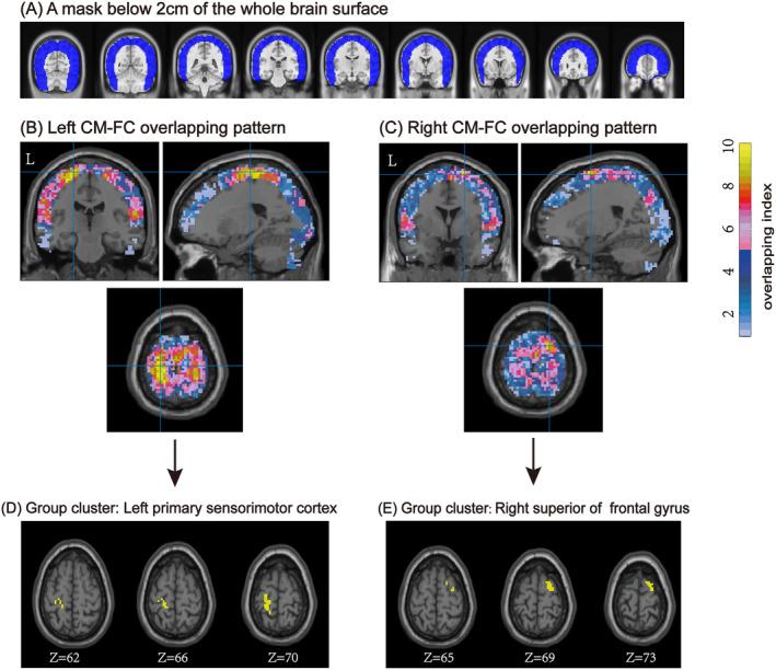 https://cdn.ncbi.nlm.nih.gov/pmc/blobs/359a/11625913/ae27fc72cc8b/CNS-30-e70120-g005.jpg