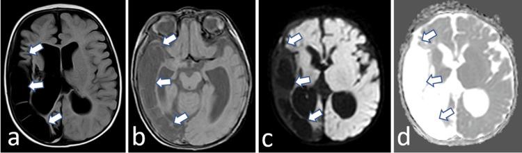 https://cdn.ncbi.nlm.nih.gov/pmc/blobs/360d/12398300/d3da4c69e113/cureus-0017-00000089133-i01.jpg