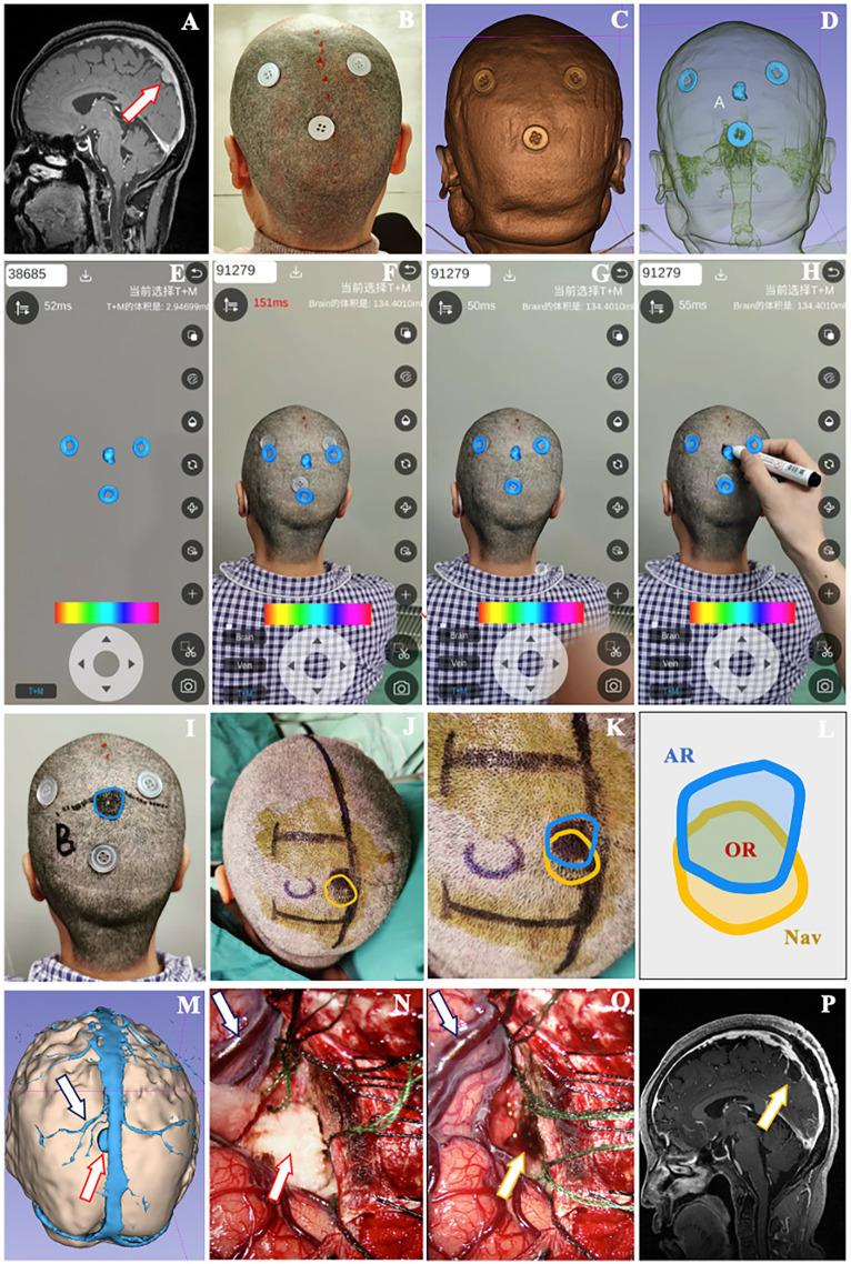 https://cdn.ncbi.nlm.nih.gov/pmc/blobs/361b/12286799/a637efb11674/fneur-16-1566557-g005.jpg