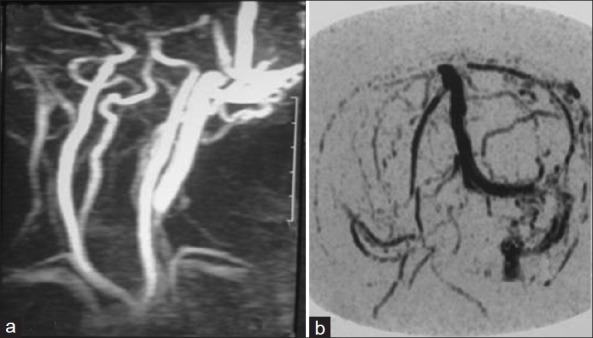 https://cdn.ncbi.nlm.nih.gov/pmc/blobs/3621/3613641/e0197a0cce91/AJNS-7-191-g003.jpg