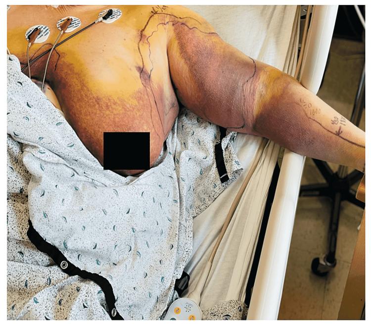 https://cdn.ncbi.nlm.nih.gov/pmc/blobs/3628/9167035/67b27df069ac/cureus-0014-00000025659-i01.jpg