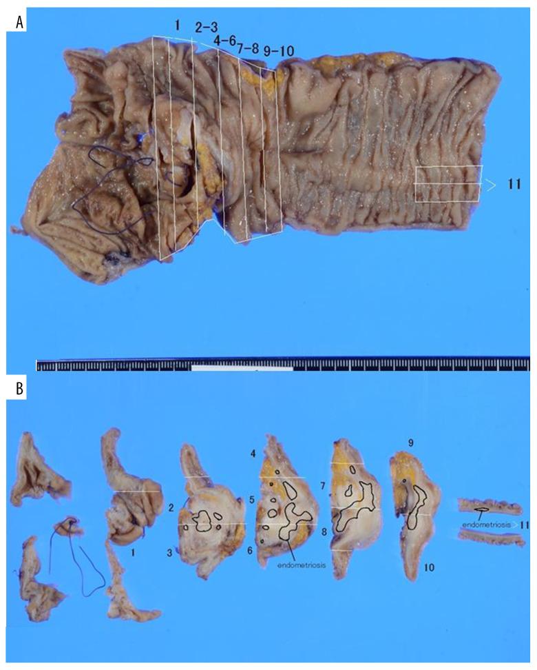 https://cdn.ncbi.nlm.nih.gov/pmc/blobs/3630/8006474/0feb859d2341/amjcaserep-22-e930141-g004.jpg