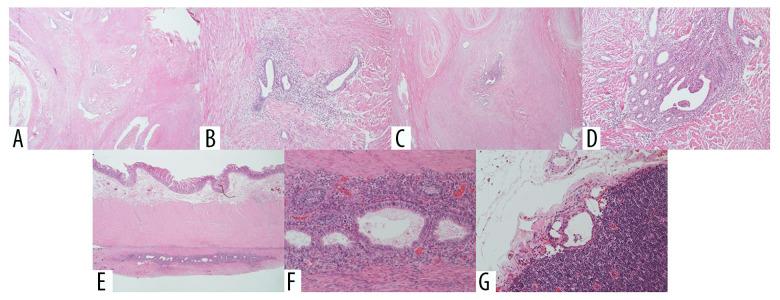 https://cdn.ncbi.nlm.nih.gov/pmc/blobs/3630/8006474/3ed5a1ca55eb/amjcaserep-22-e930141-g005.jpg