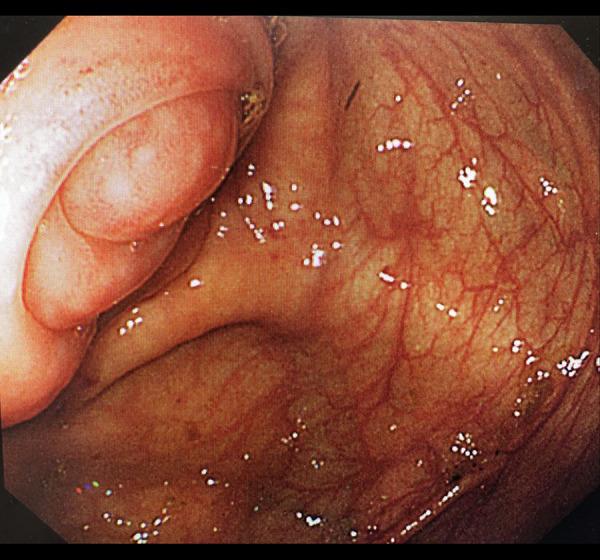 https://cdn.ncbi.nlm.nih.gov/pmc/blobs/3630/8006474/7767fd98f2b3/amjcaserep-22-e930141-g002.jpg