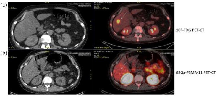 https://cdn.ncbi.nlm.nih.gov/pmc/blobs/363c/8902011/4f75a70bbd5a/10.1177_17588359221081922-fig2.jpg