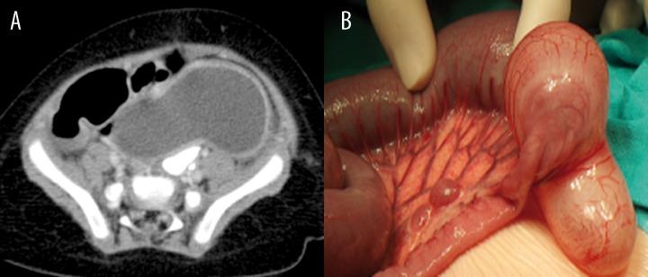 https://cdn.ncbi.nlm.nih.gov/pmc/blobs/3653/4128324/58291b244f53/poljradiol-79-243-g006.jpg