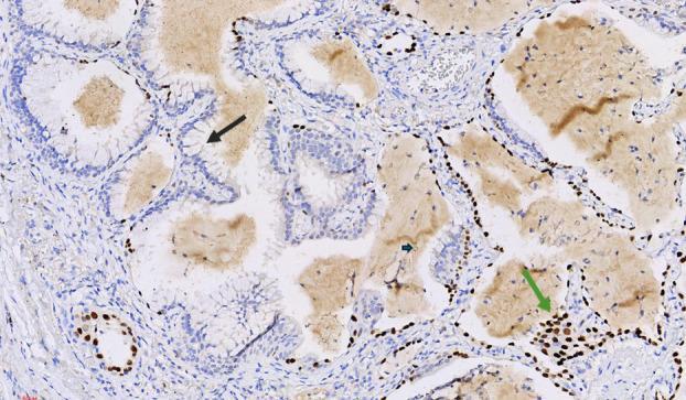 https://cdn.ncbi.nlm.nih.gov/pmc/blobs/36c9/11444930/35e032995851/TCA-15-1975-g004.jpg