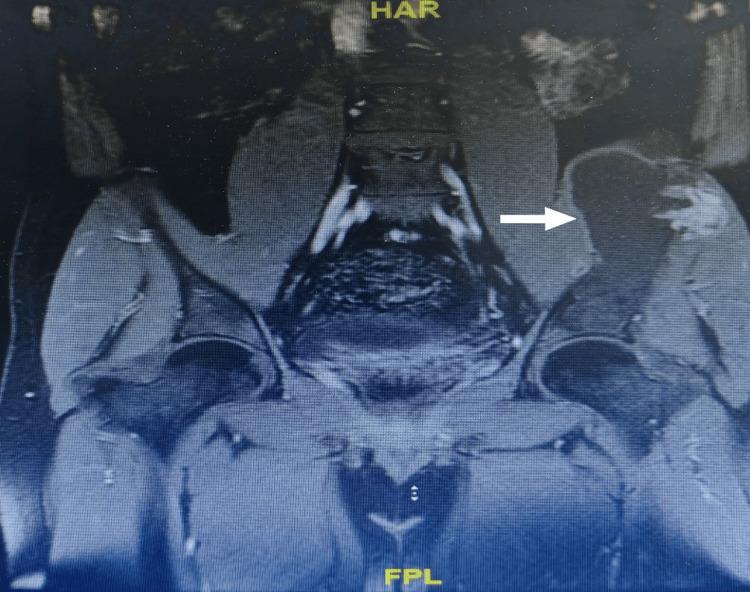 https://cdn.ncbi.nlm.nih.gov/pmc/blobs/36fb/12215177/d18010532786/cureus-0017-00000085216-i03.jpg