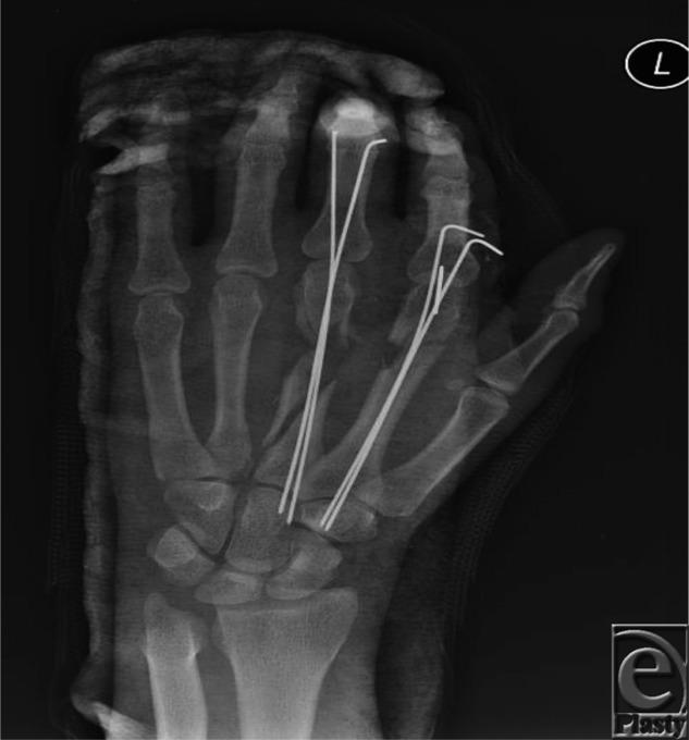 https://cdn.ncbi.nlm.nih.gov/pmc/blobs/372c/4545955/12051dc2a376/eplasty15ic47_fig1.jpg