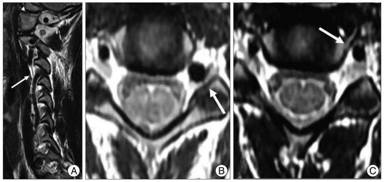 https://cdn.ncbi.nlm.nih.gov/pmc/blobs/3884/3550417/c26b7112c2e1/jkns-52-513-g002.jpg