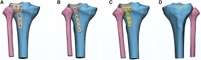 https://cdn.ncbi.nlm.nih.gov/pmc/blobs/38c5/11284072/3c4f98e66c2f/fsurg-11-1346462-g002.jpg
