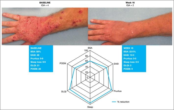 https://cdn.ncbi.nlm.nih.gov/pmc/blobs/38c8/6849829/e9b18a53cc54/BJD-181-80-g003.jpg