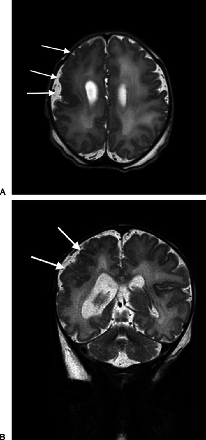 https://cdn.ncbi.nlm.nih.gov/pmc/blobs/38d7/3653533/1a40b87c8d99/ajpr01105-1.jpg