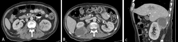 https://cdn.ncbi.nlm.nih.gov/pmc/blobs/38dd/12162156/611788db9e4f/cureus-0017-00000084052-i02.jpg