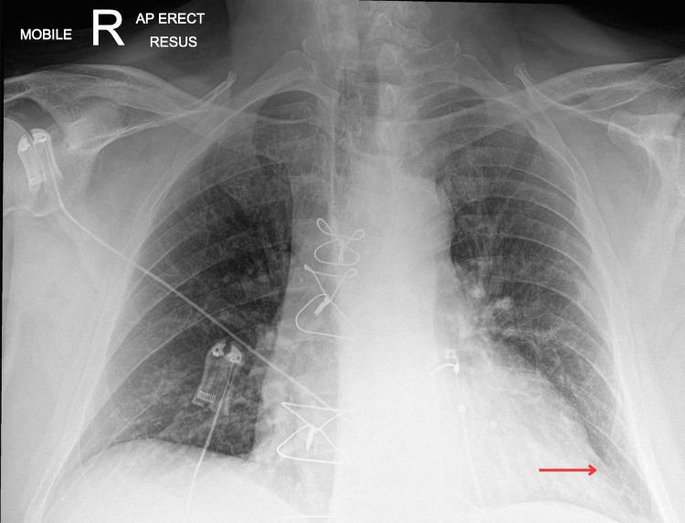 https://cdn.ncbi.nlm.nih.gov/pmc/blobs/38f5/12067022/58087ebe15ff/cureus-0017-00000082063-i02.jpg